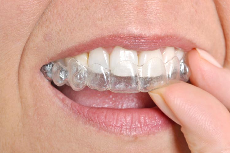 Invisalign