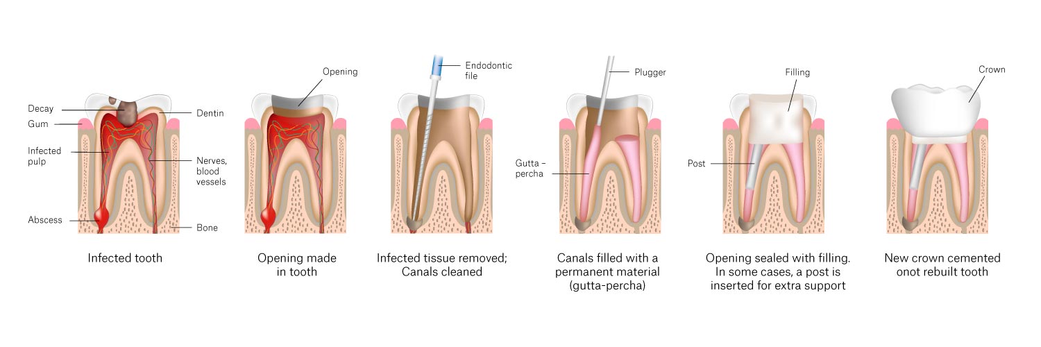 Root Canal Therapy